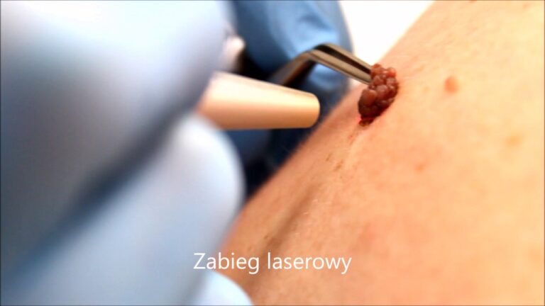 Znamiona barwnikowe – czy warto je mieć pod kontrolą?